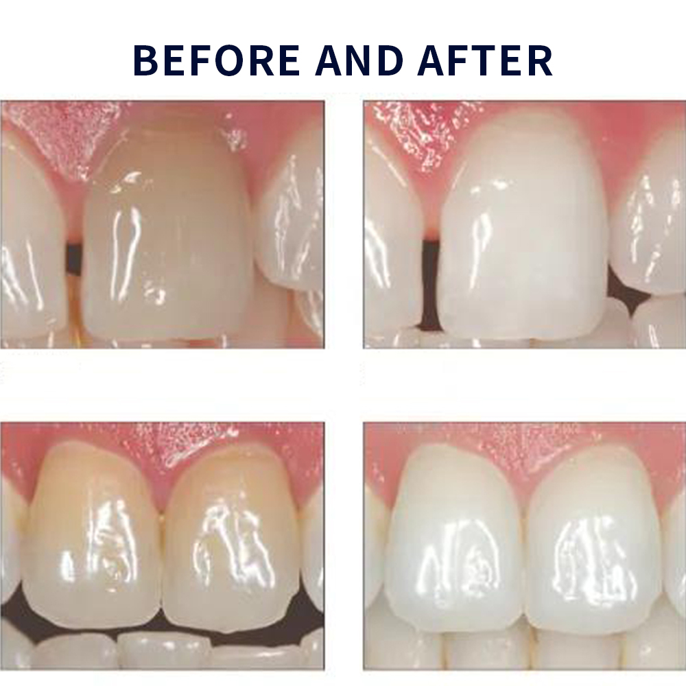 Opalwisdom-Kit de Blanchiment  - Teeth Whitening Near Me avis et prix