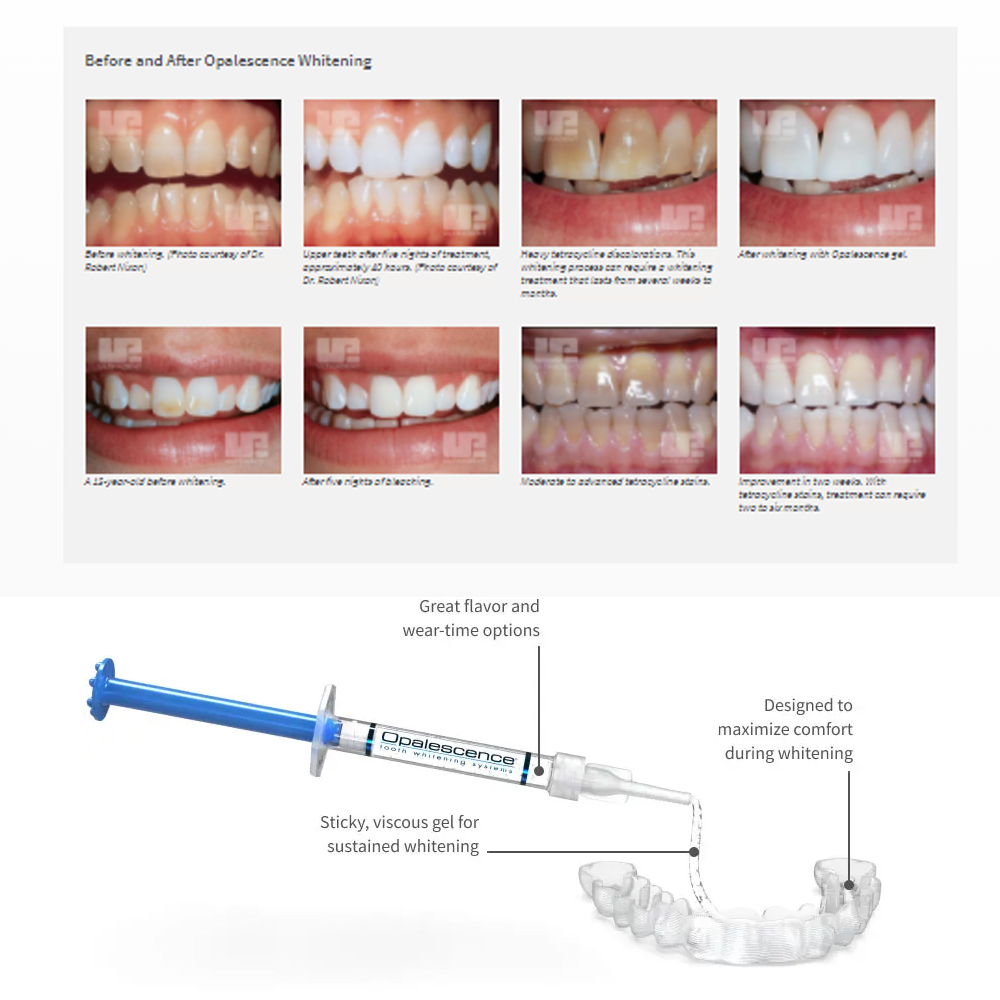 Opalwisdom-Kit de Blanchiment  - Teeth Whitening Near Me avis et prix
