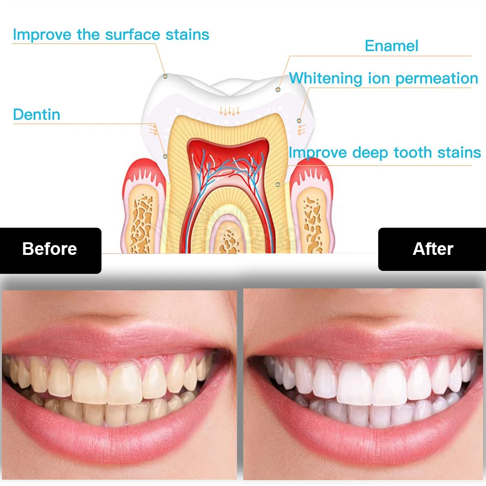 Kit de blanchiment des dents d - Teeth Whitening Pens avis et prix